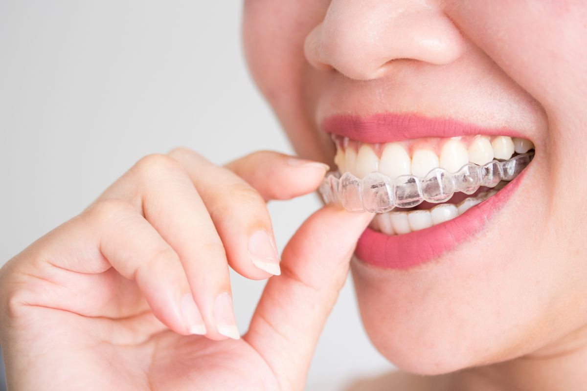 Choosing between Invisalign and braces
