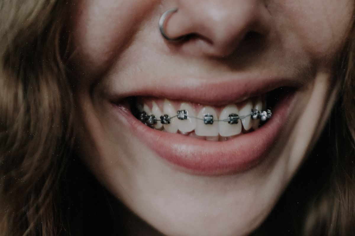 How long do you have to wear braces