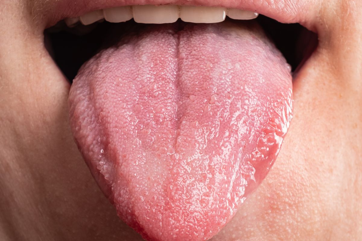 Tongue Cancer Symptoms: Early Signs, Causes, Treatment and When to Get Checked 1 What is tongue cancer