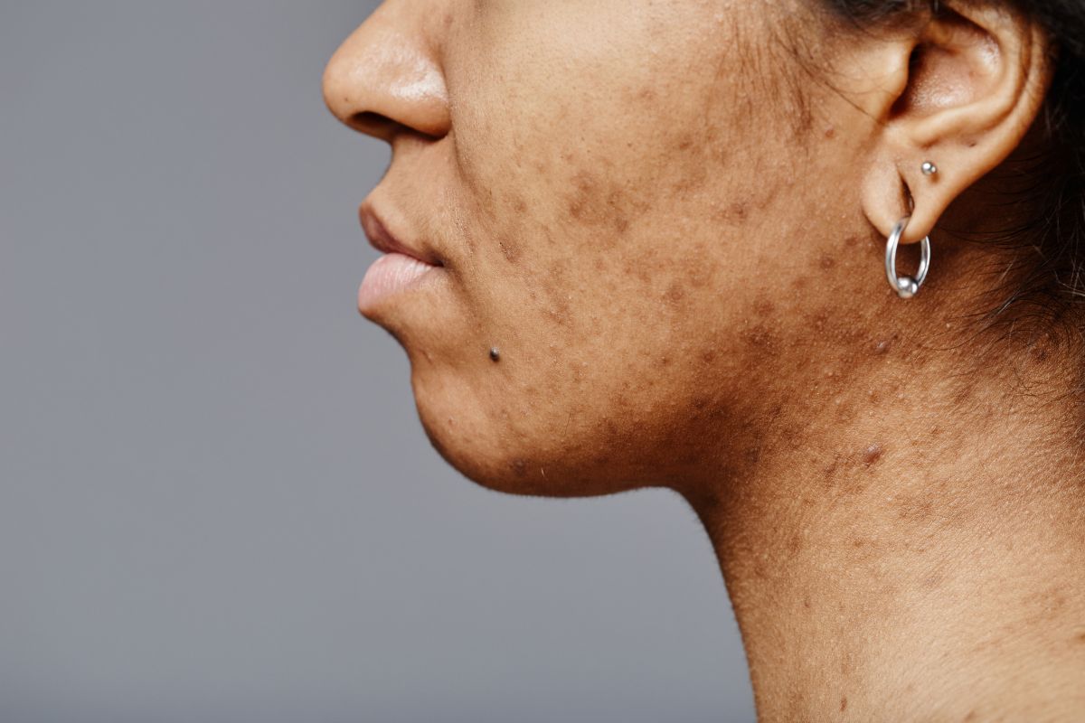 How to prevent pigmentation on the face