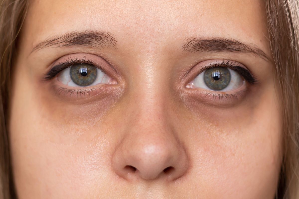 Under Eye Pigmentation vs Hollowness How to Tell Them Apart and Treat the Right Problem