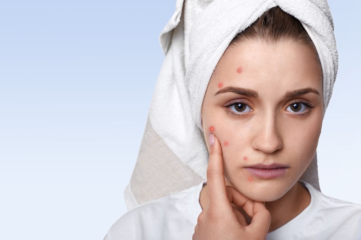 Why Does Pigmentation Appear on the Face Causes Prevention and Treatment